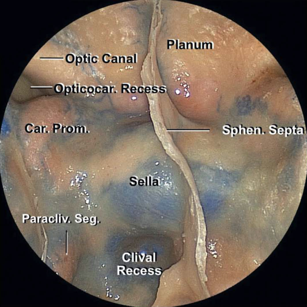 Endoscopic Expanded Transnasal Approach | Cohen Collection Endoscopic Expanded Transnasal Approach | Cohen Collection
